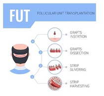 ΜΕΤΑΜΟΣΧΕΥΣΗ ΜΑΛΛΙΩΝ