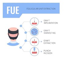 Τι πρέπει να γνωρίζεις για την μεταμόσχευση μαλλιών