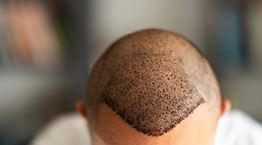 Γιατί πρέπει να μείνεις μακριά από το σεξ αν έκανες μεταμόσχευση μαλλιών