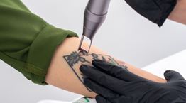 Όλα όσα πρέπει να γνωρίζεις προτού αφαιρέσεις ένα τατουάζ