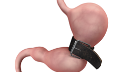 Ποια επέμβαση παχυσαρκίας σας ταιριάζει και για ποιους λόγους;