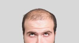 Η θεραπεία για να αντιμετωπίσεις αποτελεσματικά την αραίωση και την τριχόπτωση