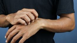 Τα κουνούπια σε τσιμπάνε γιατί είσαι 'γλυκοαίματος' - Τι λέει η επιστήμη, όμως;