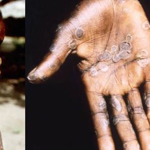 Όλα όσα γνωρίζουμε μέχρι στιγμής για την ευλογιά των πιθήκων