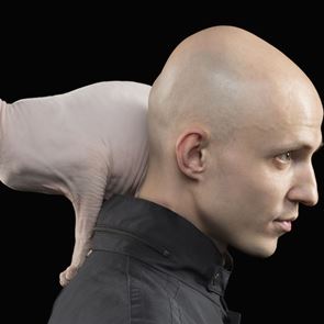 Βρέθηκε το φάρμακο κατά της φαλάκρας