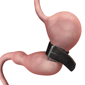 Ποια επέμβαση παχυσαρκίας σας ταιριάζει και για ποιους λόγους