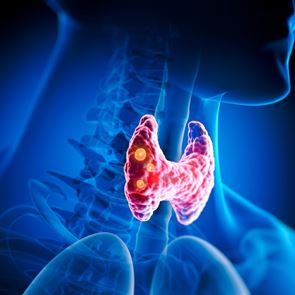 Αφαίρεση Θυρεοειδούς (Θυρεοειδεκτομή): Θα αλλάξει η ζωή μου μετά την επέμβαση; Τι πρέπει να περιμένω