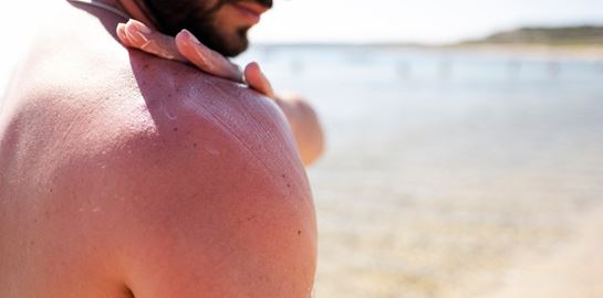 Πώς να ανακουφιστείς από το κάψιμο του ήλιου πιο γρήγορα από ποτέ