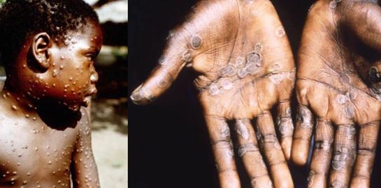 Όλα όσα γνωρίζουμε μέχρι στιγμής για την ευλογιά των πιθήκων