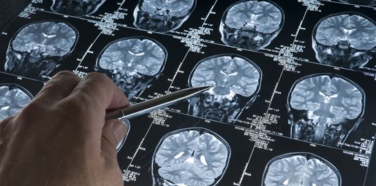 Αυτό το φάρμακο μειώνει 70% τις πιθανότητες για Αλτσχάιμερ