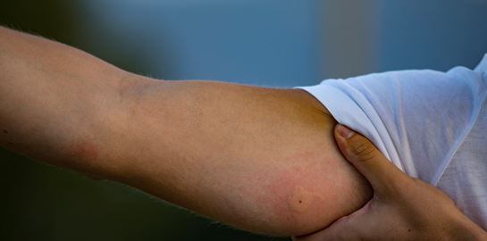 Οδηγός επιβίωσης από τσίμπημα εντόμου, τσούχτρας ή δάγκωμα φιδιού