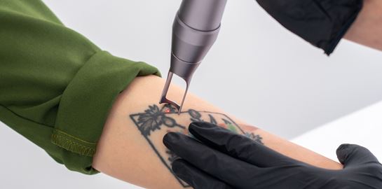 Όλα όσα πρέπει να γνωρίζεις προτού αφαιρέσεις ένα τατουάζ