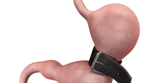 Ποια επέμβαση παχυσαρκίας σας ταιριάζει και για ποιους λόγους;