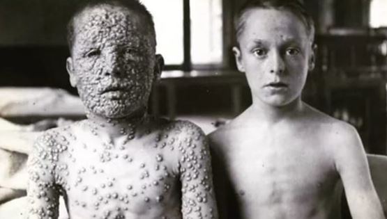 Πώς τα εμβόλια εξόντωσαν την ευλογιά και όχι μόνο