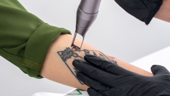Όλα όσα πρέπει να γνωρίζεις προτού αφαιρέσεις ένα τατουάζ