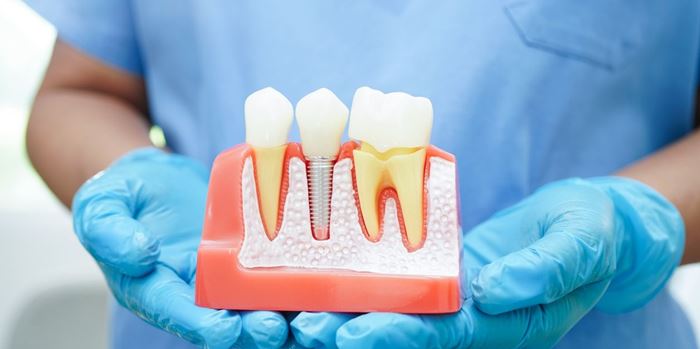 Αποκτήστε ξανά το χαμόγελό σας με εμφυτεύματα δοντιών σε 1 ημέρα