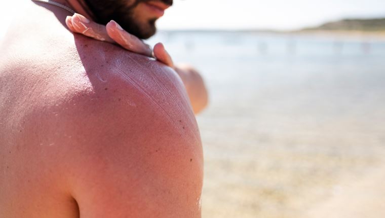 Πώς να ανακουφιστείς από το κάψιμο του ήλιου πιο γρήγορα από ποτέ