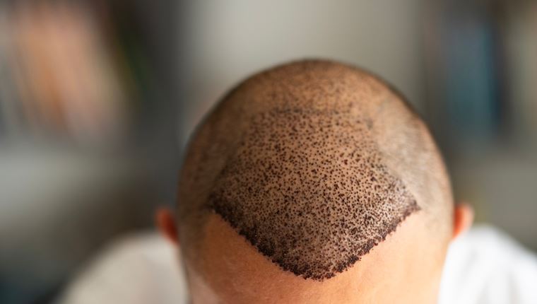 Γιατί πρέπει να μείνεις μακριά από το σεξ αν έκανες μεταμόσχευση μαλλιών