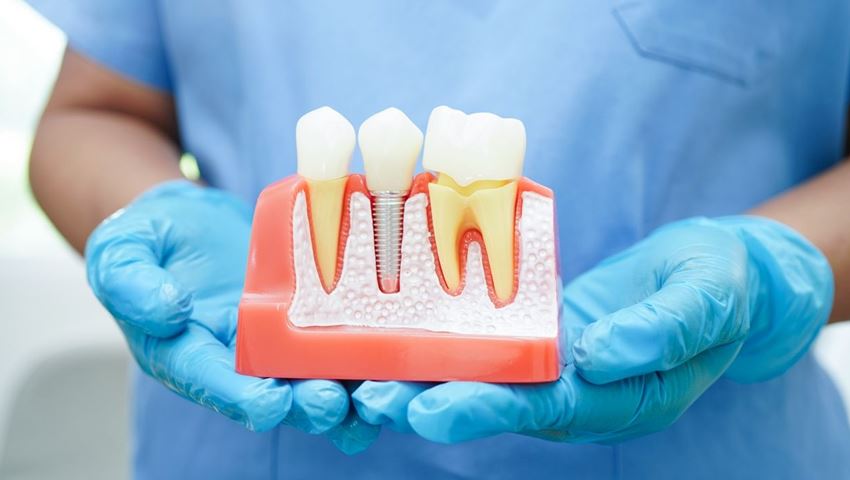 Αποκτήστε ξανά το χαμόγελό σας με εμφυτεύματα δοντιών σε 1 ημέρα