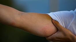 Οδηγός επιβίωσης από τσίμπημα εντόμου, τσούχτρας ή δάγκωμα φιδιού