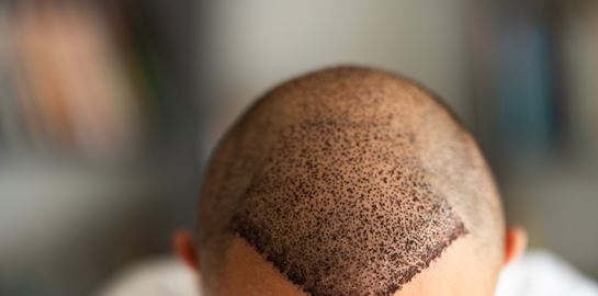 Γιατί πρέπει να μείνεις μακριά από το σεξ αν έκανες μεταμόσχευση μαλλιών